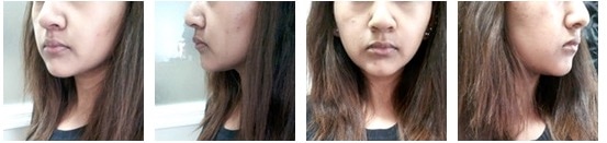 Buccal fat removal in new york