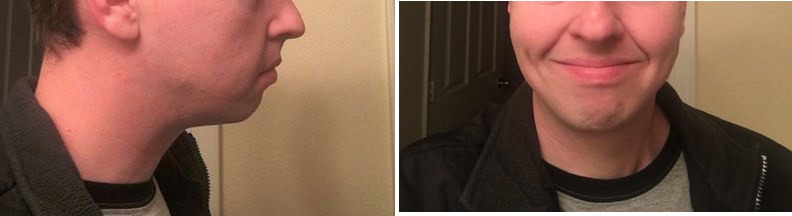 best buccal fat removal